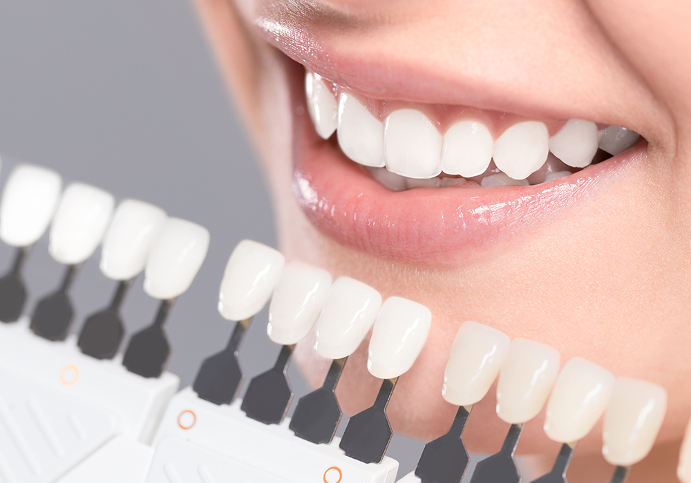 ホワイトニング（オフィス・ホーム）